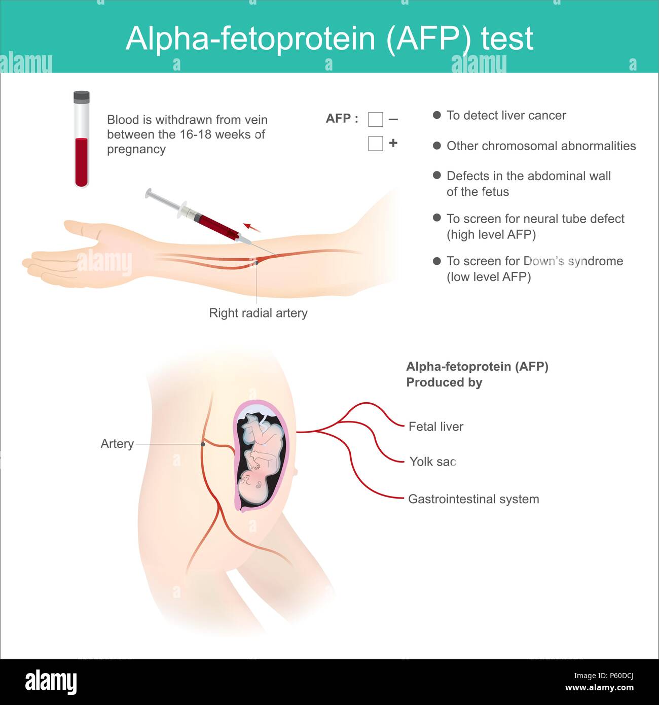 Alfa-fetoproteina (AFP) test. Utilizzare l'analisi mediante AFP. di livello per rilevare il cancro al fegato, e l'uso di schermo per la sindrome di down. Illustrazione Vettoriale