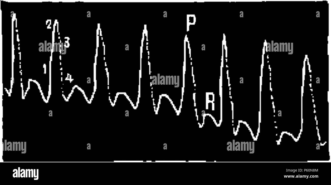 555 FI-d053-graphique pouls artère radiale Foto Stock
