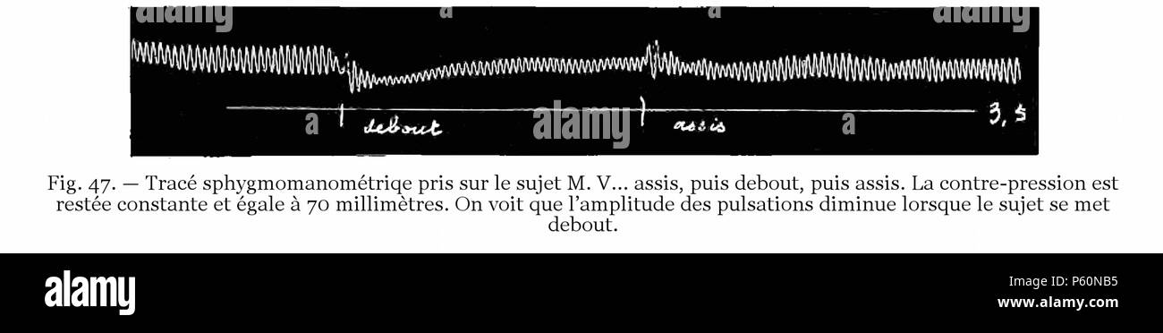 555 FI-d123-fig. 47 - Variazione tracé sphygmomanométrique selon posizione Foto Stock