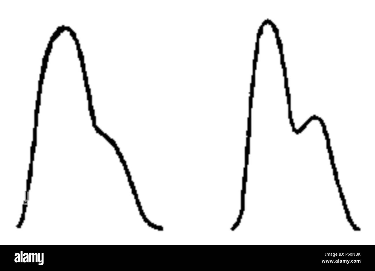 555 FI-d099-fig. 32 - changement forme du pouls Foto Stock