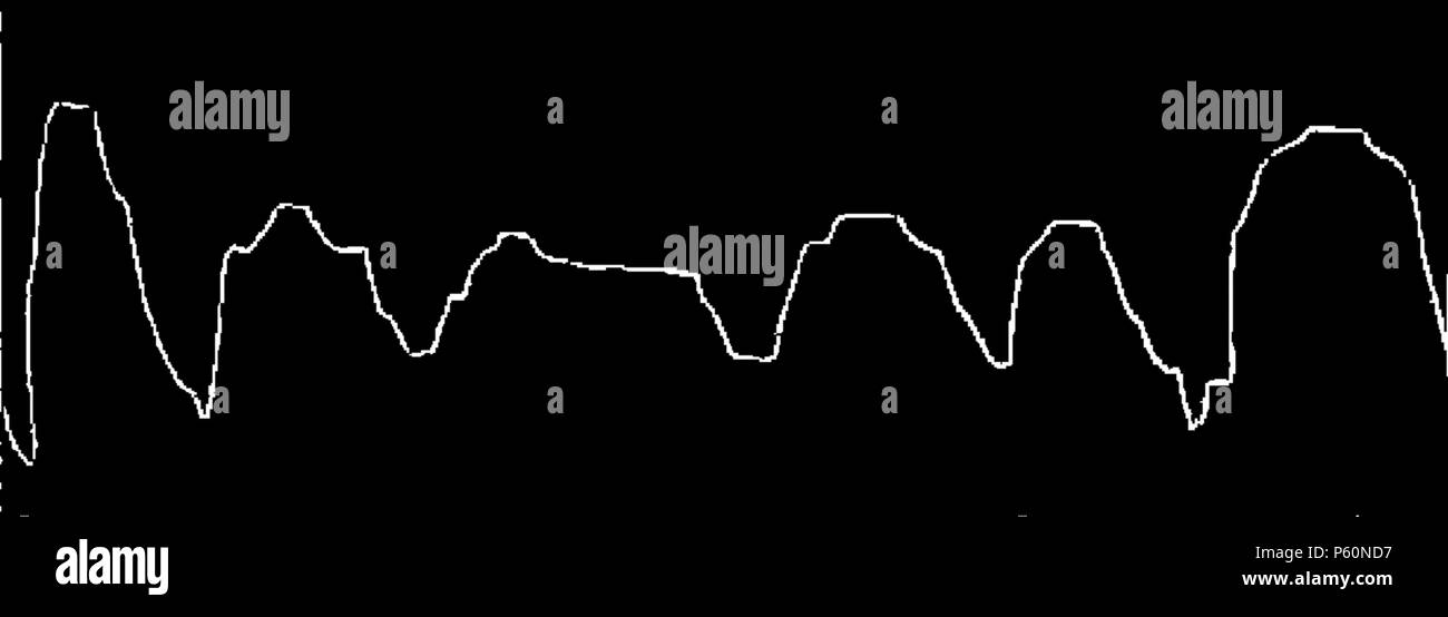 555 FI-d163-fig. 61 - Tracé respiratoire donné par débutant delle nazioni unite Foto Stock