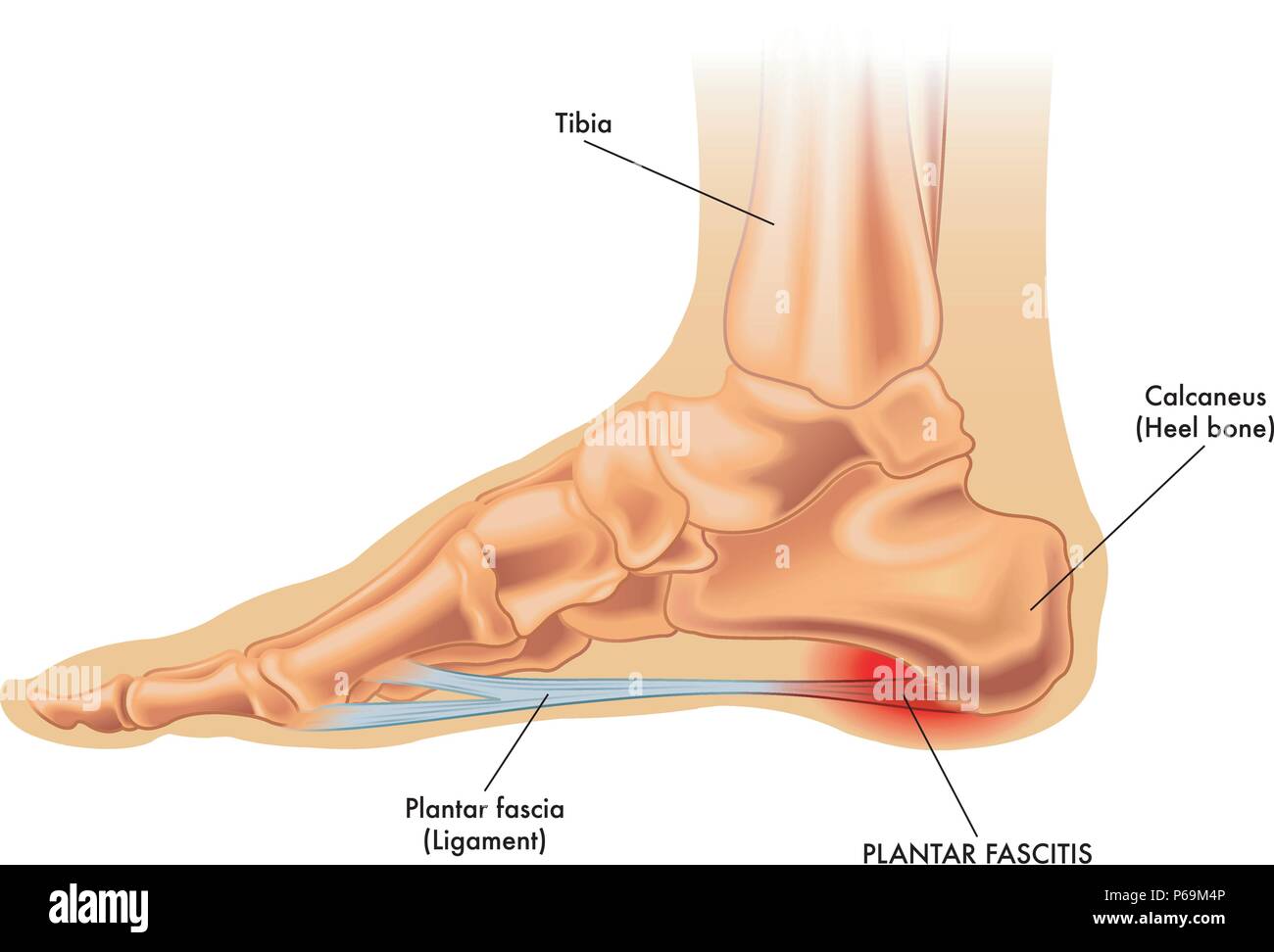 Un vettore Illustrazione medica di anatomia del piede con i sintomi di fasciitis plantare. Illustrazione Vettoriale
