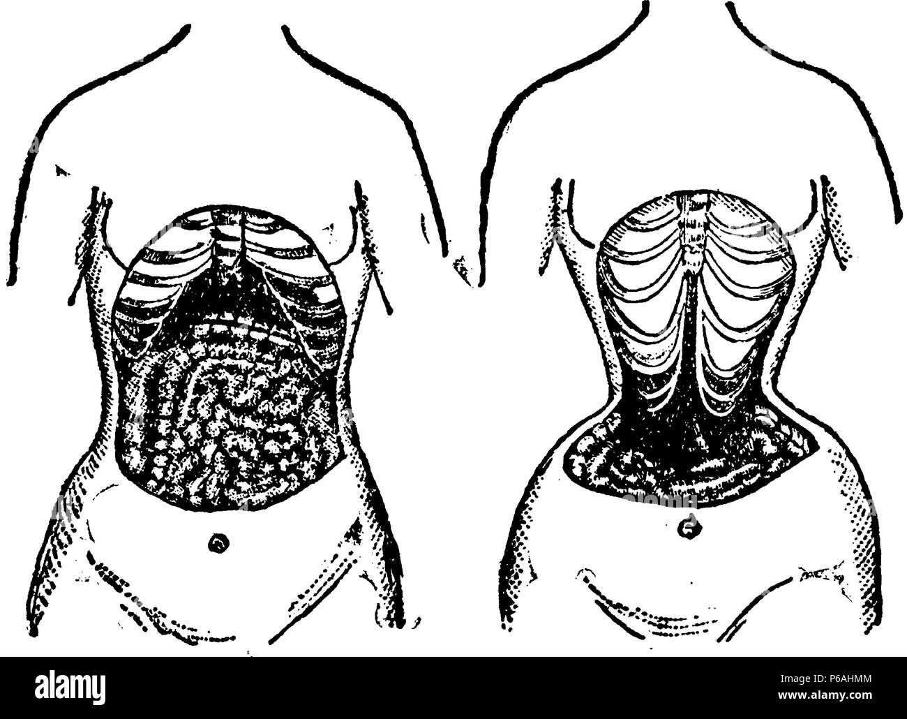 Due immagini di una donna di torso; uno che mostra una donna senza un  corsetto, l'