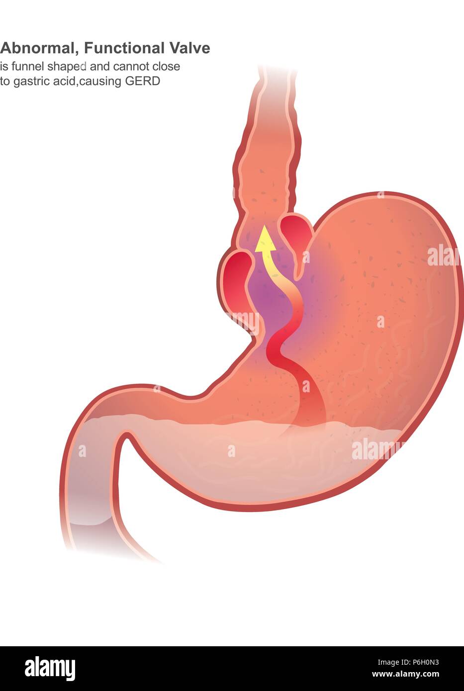 Malattia da reflusso gastroesofageo GERD, noto anche come reflusso acido, è sul lungo termine una condizione per cui i contenuti dello stomaco tornare indietro fino all'esofago, resul Illustrazione Vettoriale
