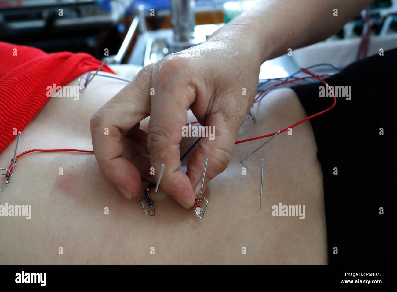 Tradizionale vietnamita medicina clinica. L'agopuntura. Cu Chi. Il Vietnam. Foto Stock