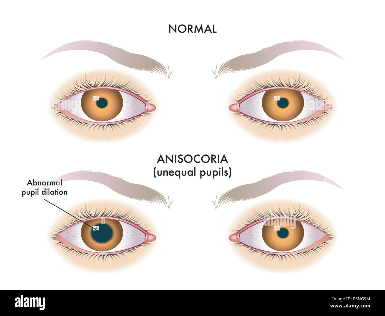 Vettore Illustrazione medica dei sintomi della disparità di alunni, chiamato anche anisocoria Illustrazione Vettoriale