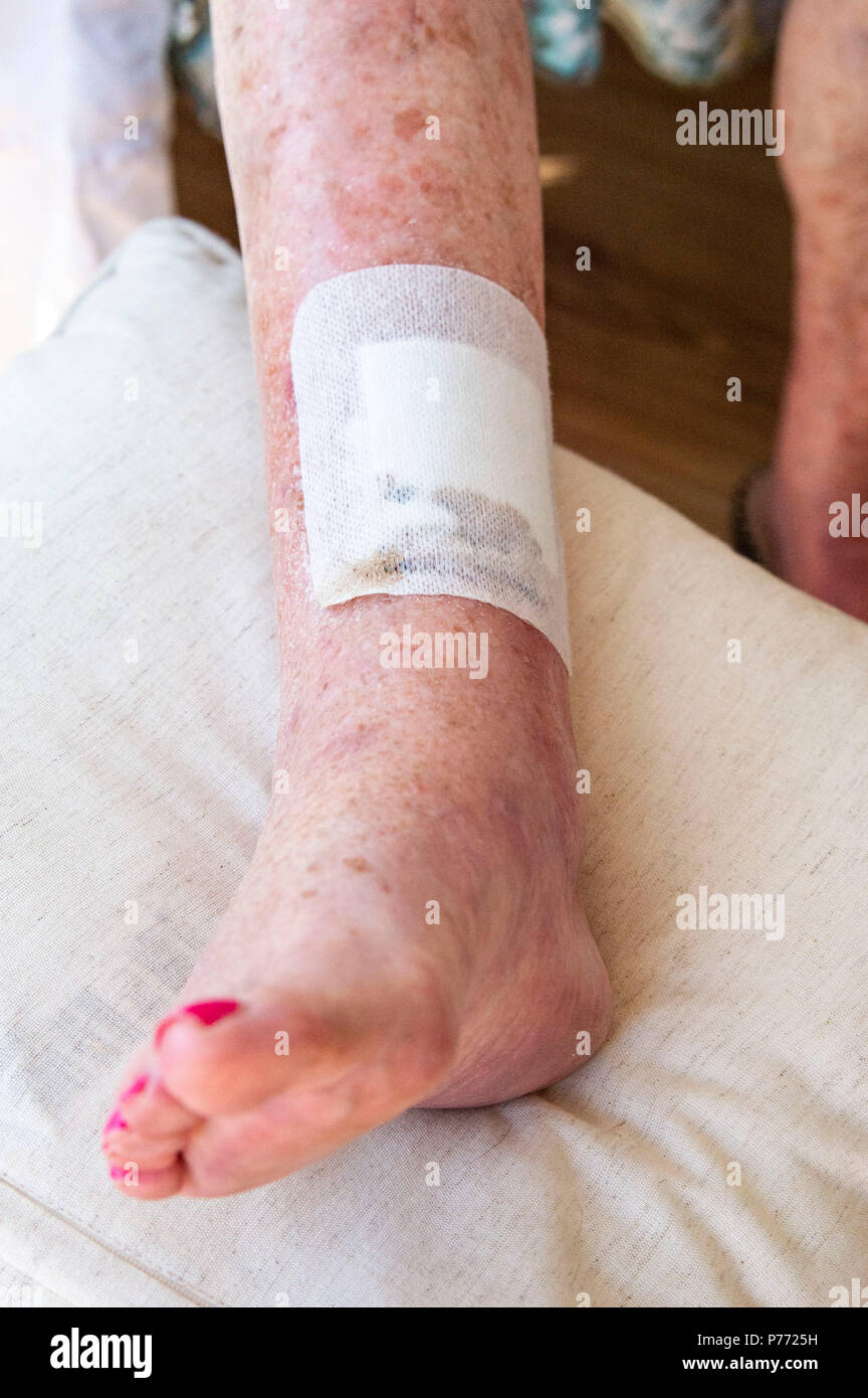 Donna anziana con cancro della pelle sulle gambe che mostra la cicatrice dopo distacco plus caviglia gonfie Foto Stock