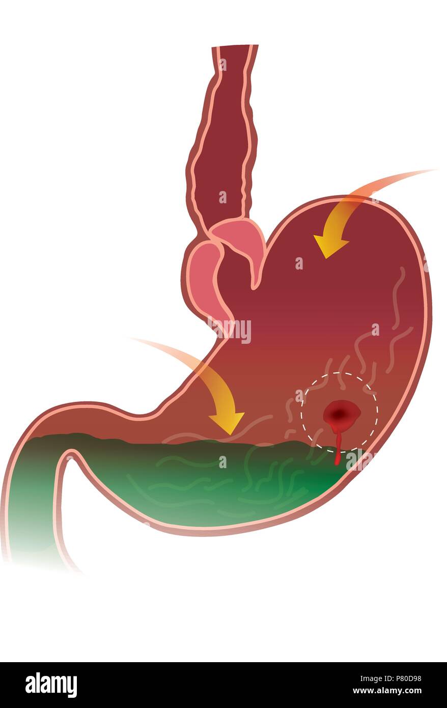 Stomaco ulcera peptica. Anatomia del corpo. Illustrazione. Illustrazione Vettoriale