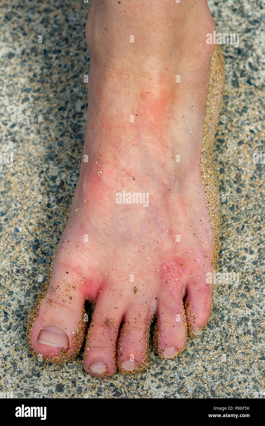 Bantry, Irlanda. 9 Luglio, 2018. Una medusa pungo 8 anno vecchio Mattie Abele sulla spiaggia di Bantry in un momento precedente della giornata odierna. Le meduse sono fatte proliferare in acque irlandesi a causa del calore e il loro accoppiamento stagione. L'ondata di caldo è impostata per continuare per la prossima settimana con temperature in bilico intorno alla metà di alta 20° Celsius mark. Credito: Andy Gibson/Alamy Live News. Foto Stock