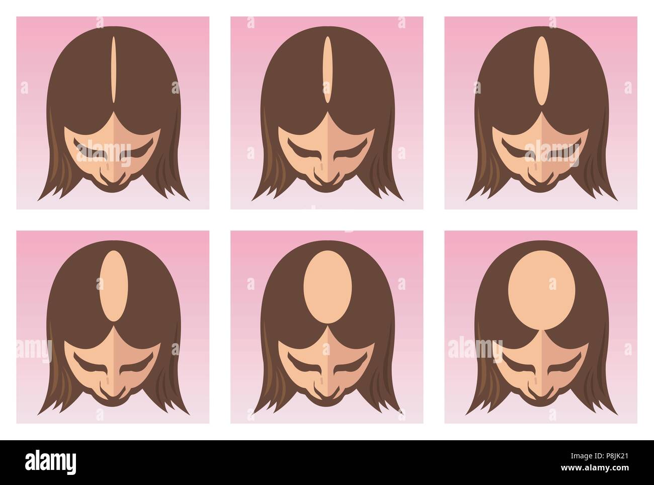 Un vettore Illustrazione medica degli stadi di alopecia femminile o di perdita di capelli. Illustrazione Vettoriale