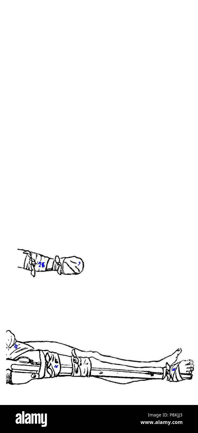 314 Grierson 80a Triangulo de Esmarch 4de4 Foto Stock