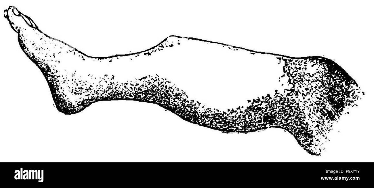 . 314 Grierson 34 Fractura semplice de tibia Foto Stock