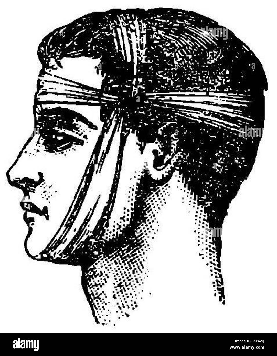 314 Grierson 63 Compresión mecánica con venda del temporal izquierdo Foto Stock