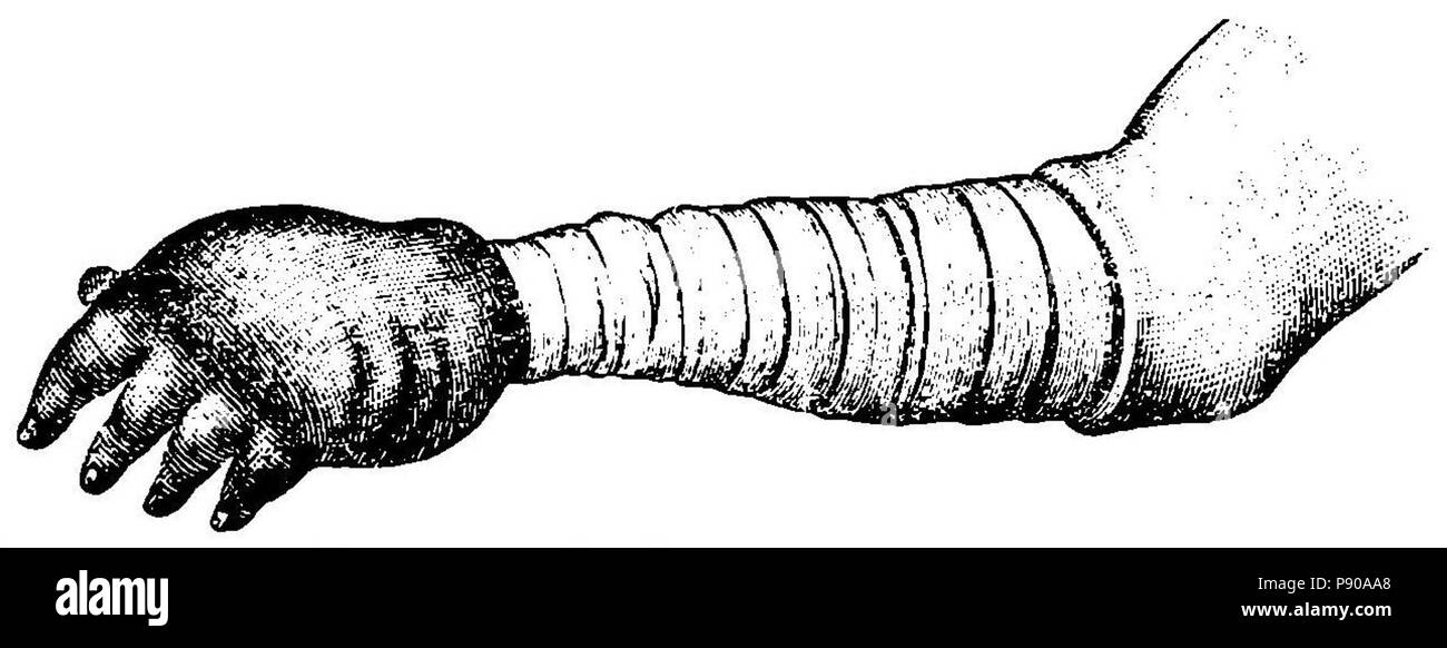 314 Grierson 74 Gangrena en mano por compresión Foto Stock