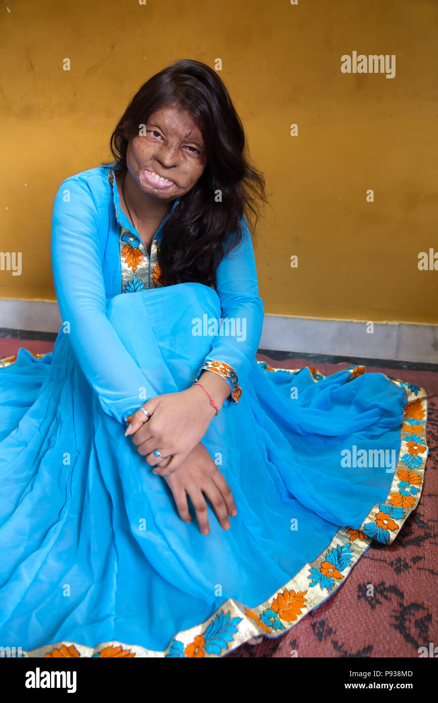 Roopa, vittima di attacco acido di Delhi (da arrestare gli attacchi di acido campagna, India) Foto Stock
