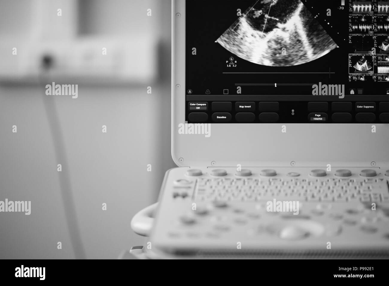 Sulla schermata di ultrasuoni, l'immagine del cuore in quattro-la posizione della camera e il metodo Doppler mostra rigurgito tricuspidale. Foto Stock