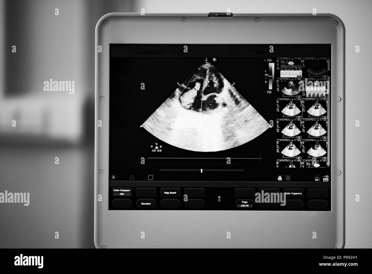Sullo schermo del dispositivo di scansione a ultrasuoni, il cuore immagine in quattro-la posizione della camera e contrassegnati dal colore blu e rosso metodo doppler sono regurgit valvola Foto Stock
