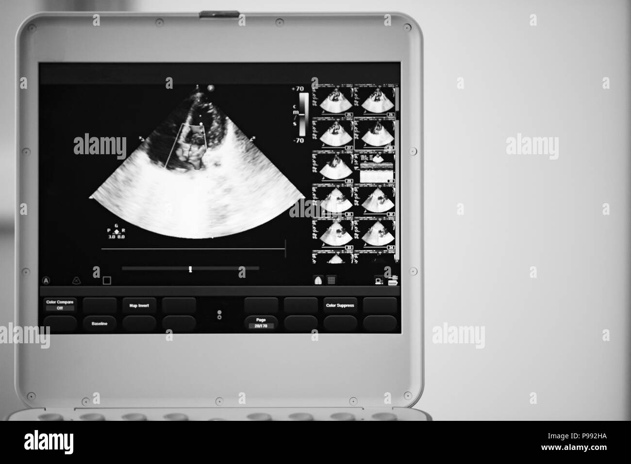 Sullo schermo del dispositivo di scansione a ultrasuoni, il cuore immagine in quattro-la posizione della camera e contrassegnati dal colore blu e rosso metodo doppler sono regurgit valvola Foto Stock