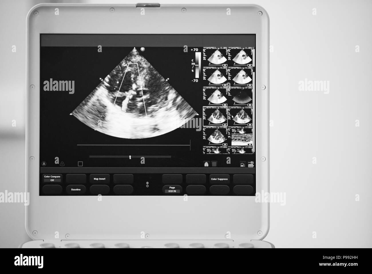 Sullo schermo del dispositivo di scansione a ultrasuoni, il cuore immagine in quattro-la posizione della camera e contrassegnati dal colore blu e rosso metodo doppler sono regurgit valvola Foto Stock