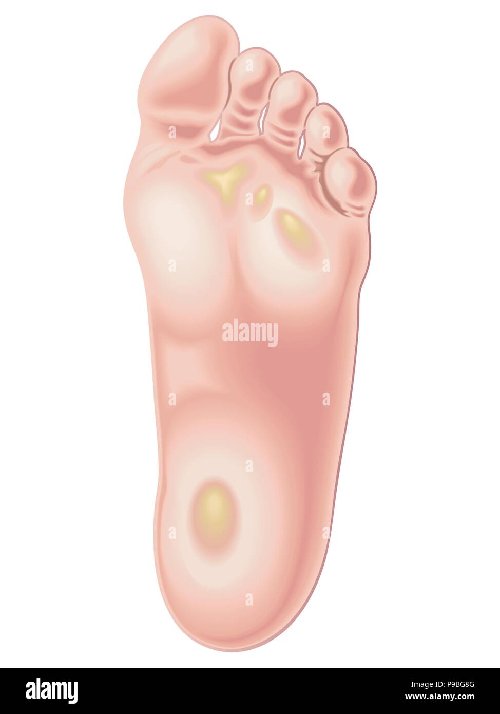 Vettore Illustrazione medica della posizione di calli sui piedi Illustrazione Vettoriale