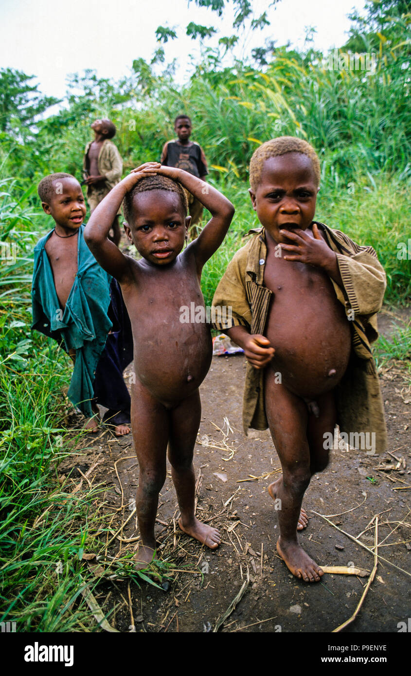 Pigmeo di bambini che soffrono di vermi parassiti, la Vallata Semliki, Uganda, Africa. Foto Stock