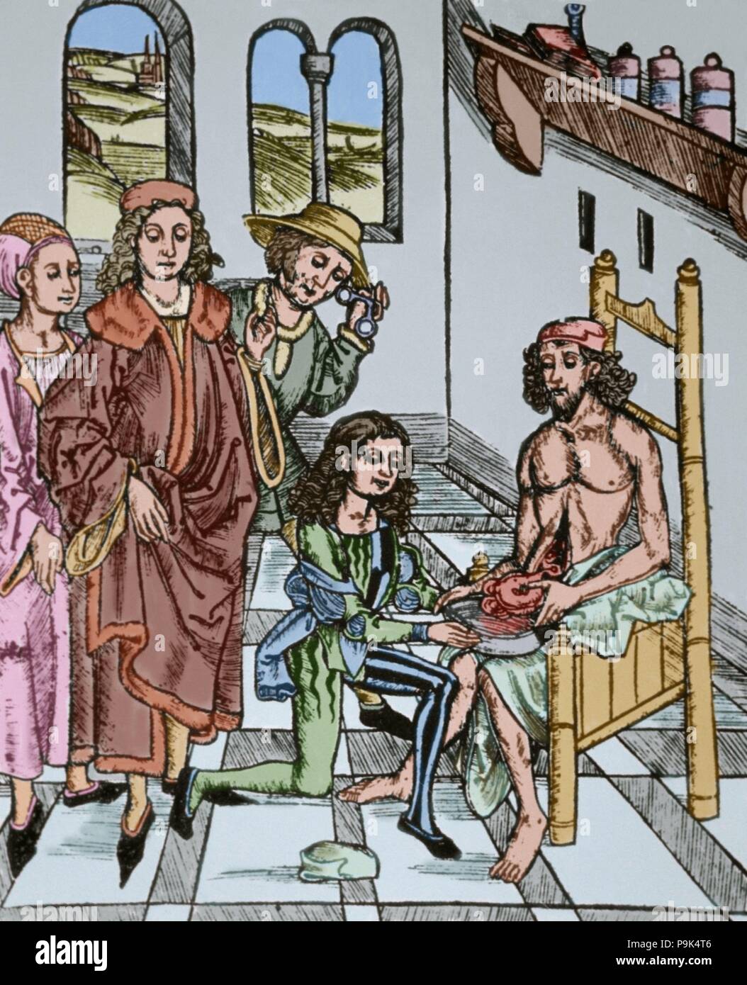 La storia della medicina. La saturazione dell'intestino. Xilografia in Dies ist das Buch Der Chirurgia (questo è il libro della chirurgia), xv secolo. Incisione colorata. Foto Stock