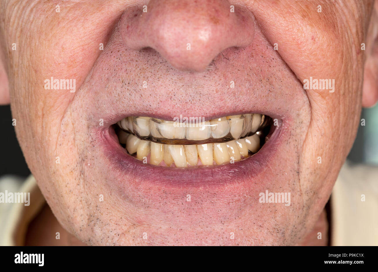 Senior uomo mettendo una guardia notturna su denti storti Foto Stock