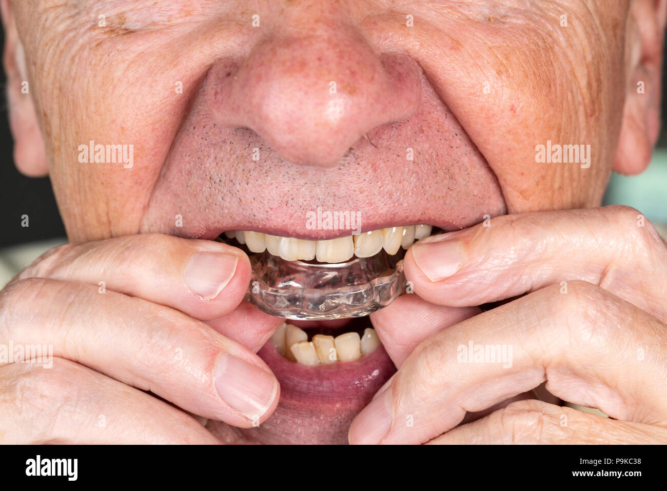 Senior uomo mettendo una guardia notturna su denti storti Foto Stock