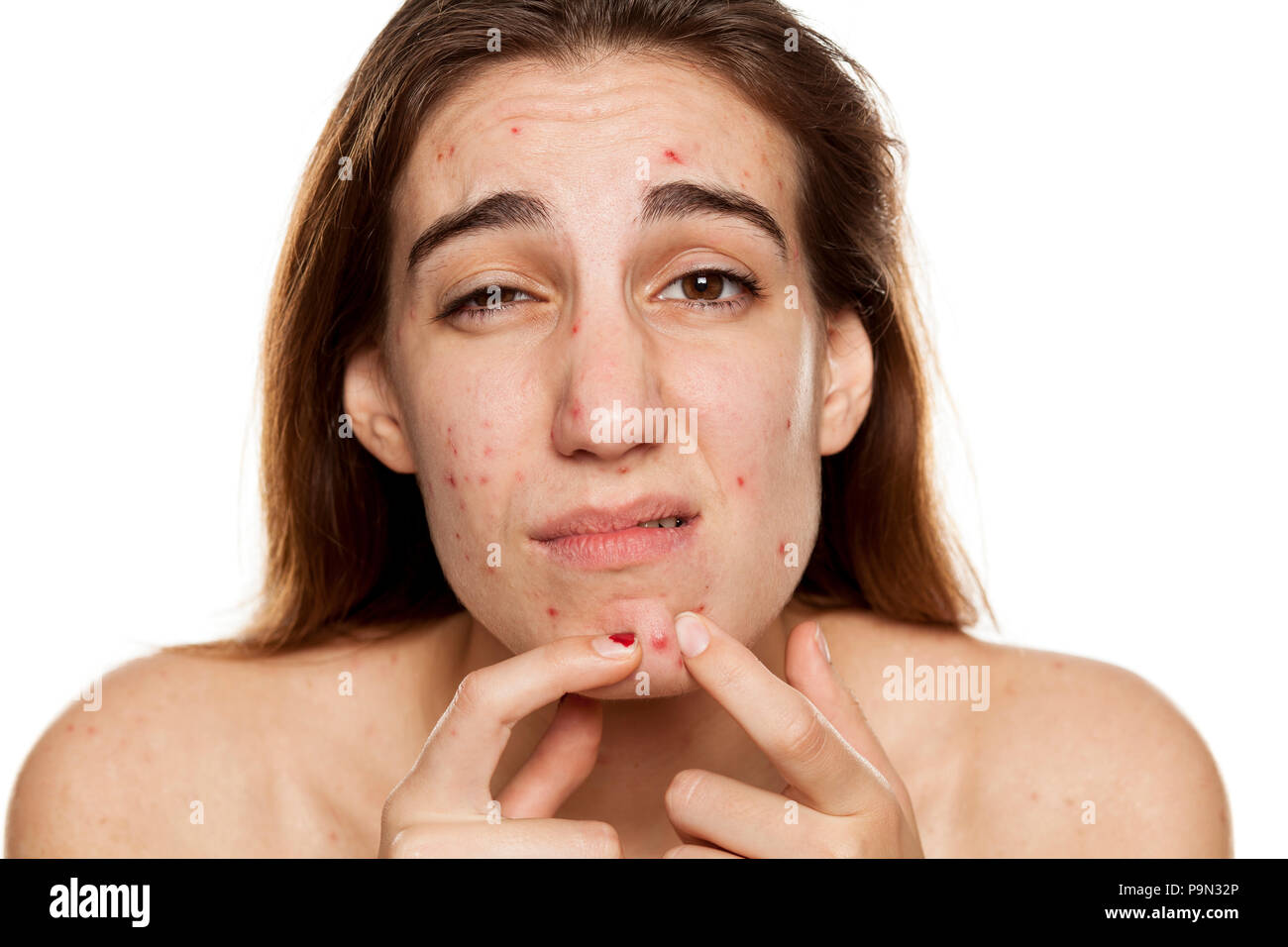 Giovane donna infelice con problemi di pelle e senza trucco spremere la sua acne su sfondo bianco Foto Stock