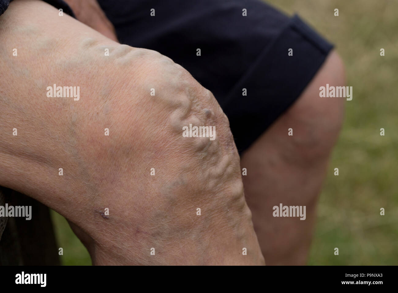 Ingrandita vene varicose sul ginocchio della donna senior UK Foto Stock