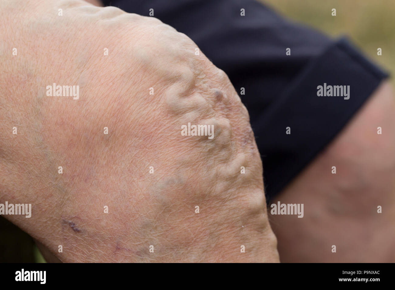 Ingrandita vene varicose sul ginocchio della donna senior UK Foto Stock