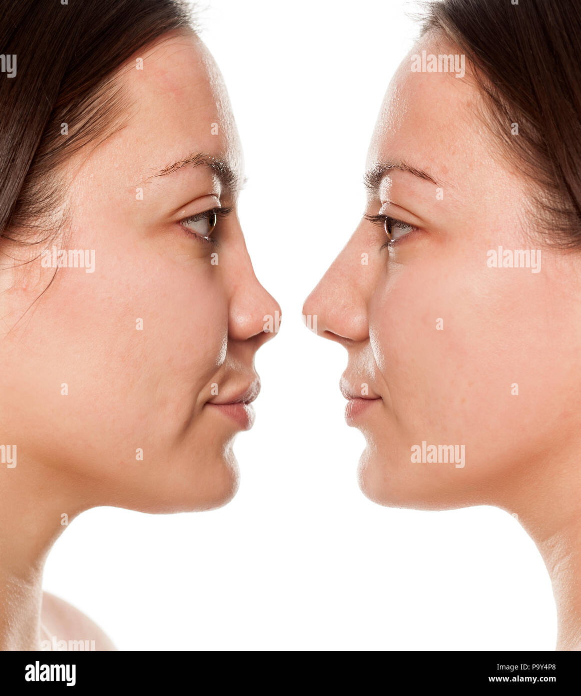 Profilo di donna, prima e dopo la chirurgia del naso Foto Stock
