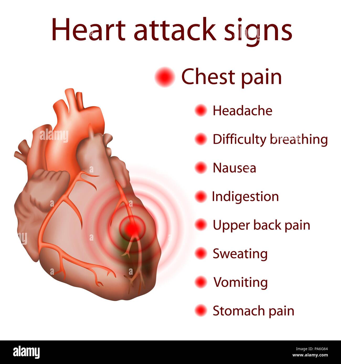 Attacco di cuore (infarto del miocardio) segni, illustrazione. Foto Stock