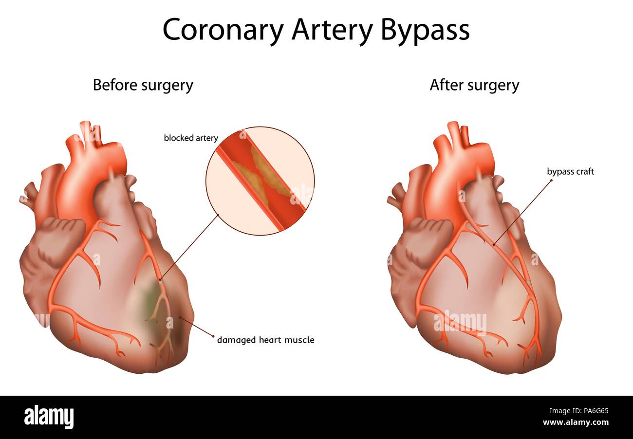 Di bypass di arteria coronaria, illustrazione. L'innesto di bypass consente di ripristinare il normale flusso sanguigno ad un ostacolato arteria coronaria. Foto Stock