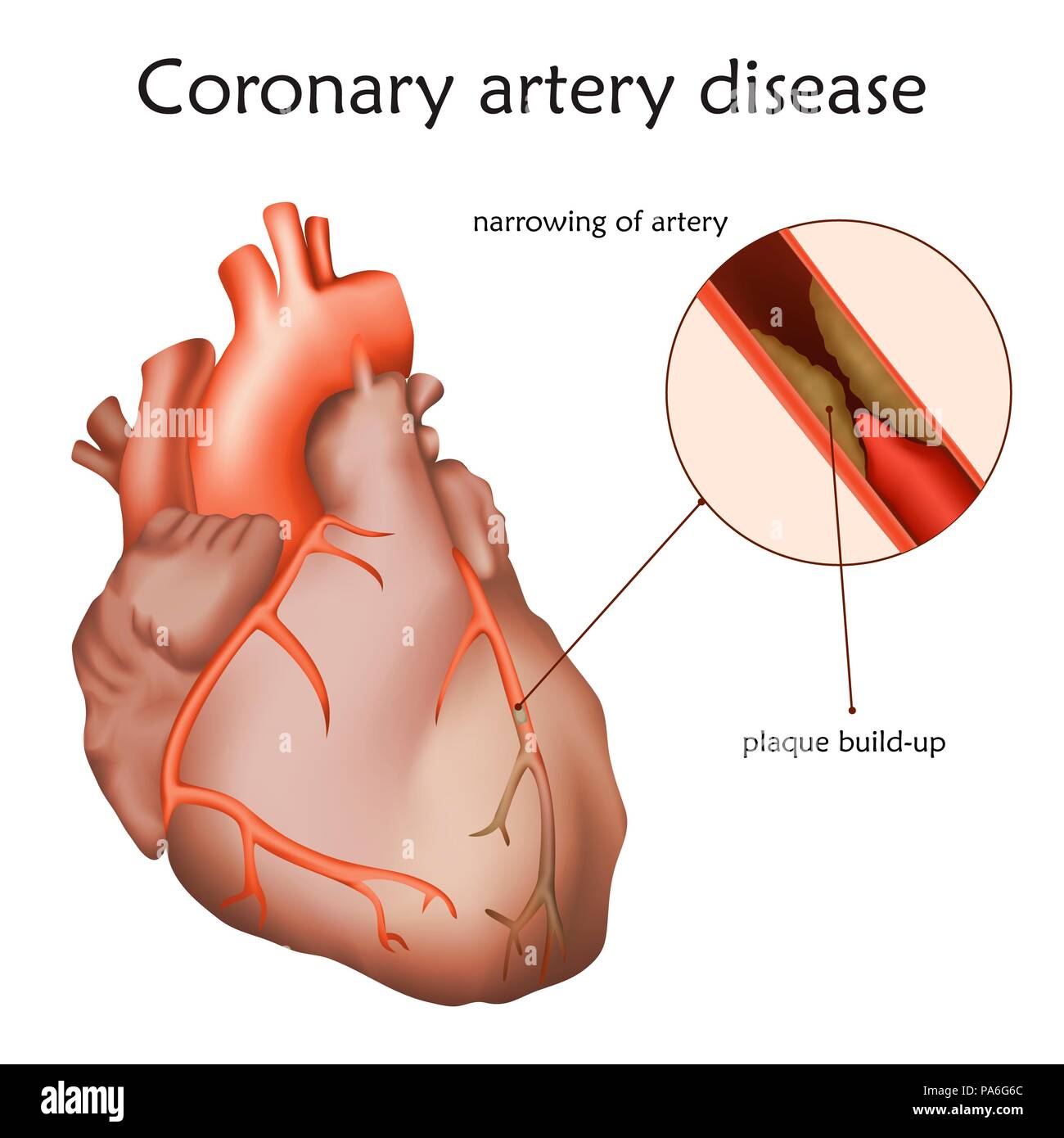 La malattia delle arterie coronarie, illustrazione. Blocco di una arteria coronaria ha portato al muscolo cardiaco danneggiato. Foto Stock