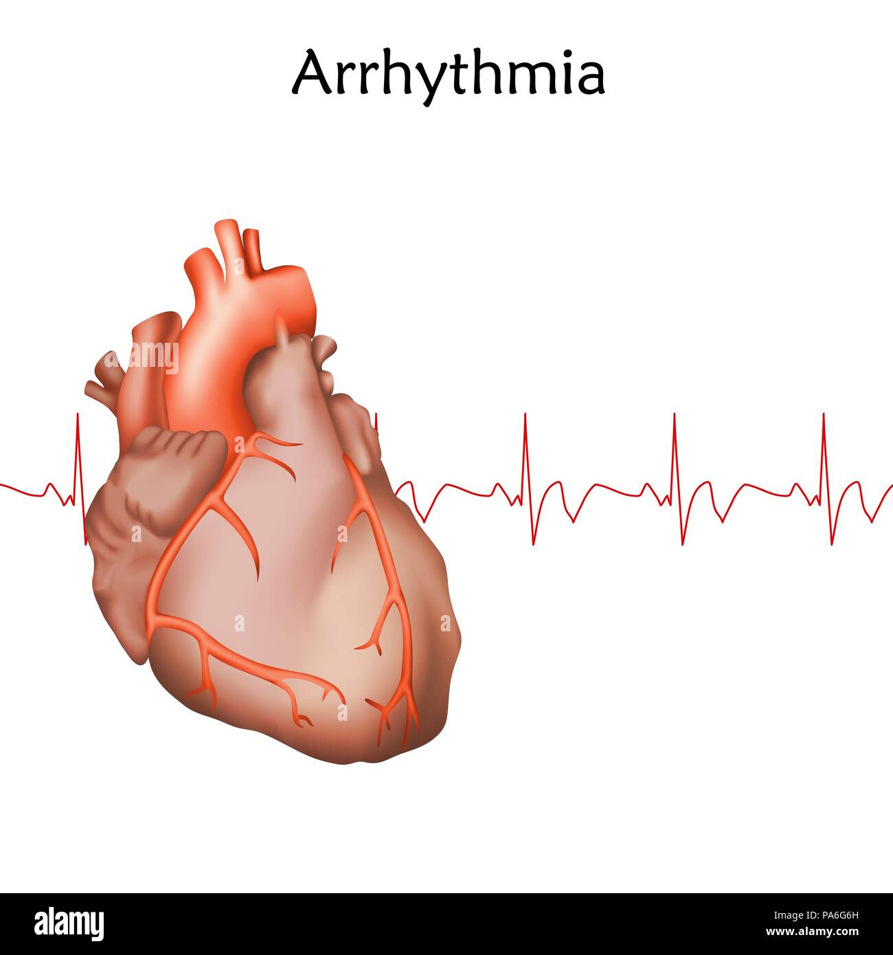 Aritmia cardiaca, illustrazione Foto Stock