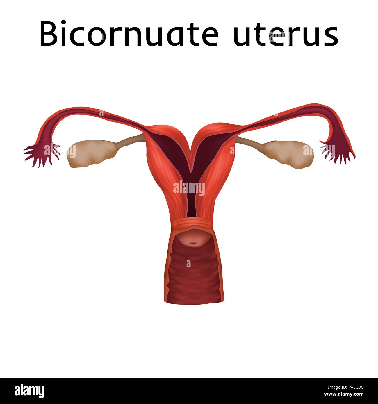 Bicornuate utero, illustrazione. Un utero bicornuate è composta da due corni separati da un setto. Foto Stock