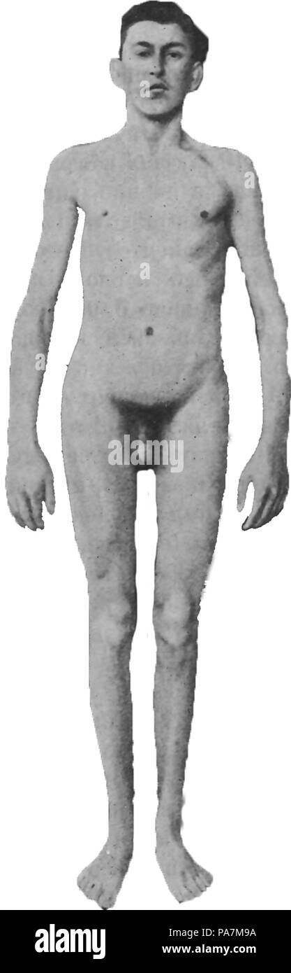 617 eunuchoid allungata. Schizofrenia, età 18 Foto Stock