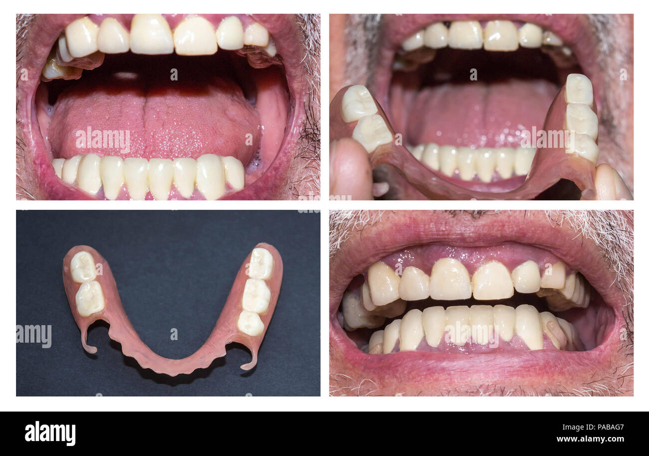 Riabilitazione dentale con superiore e inferiore protesi, prima e dopo il trattamento Foto Stock