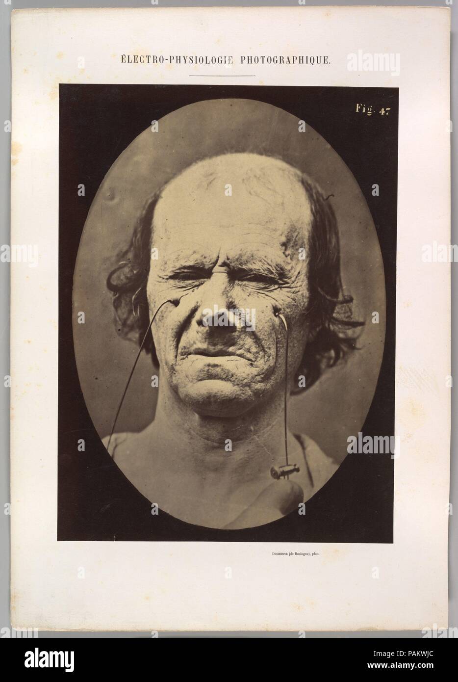 Figura 47: un suggerimento di questo stesso piangendo. Artista: Guillaume-Benjamin-Amand Duchenne de Boulogne (Francese, 1806-1875); Adrien Tournachon (Francese, 1825-1903). Dimensioni: immagine (ovale): 27,9 × 20,3 cm (11 × 8 poll.) foglio: 29,6 × 21,8 cm (11 5/8 × 8 9/16 in.). Montaggio: 40,2 × 28,4 cm (15 13/16 × 11 3/16 in.). Data: 1854-56, stampati 1862. Museo: Metropolitan Museum of Art di New York, Stati Uniti d'America. Foto Stock