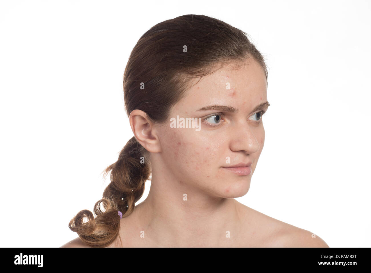 Bella ragazza giovane con il rosso e bianco acne sul viso. Prima e dopo la crema con una spugna. Smettere di acne su uno sfondo bianco. Foto Stock