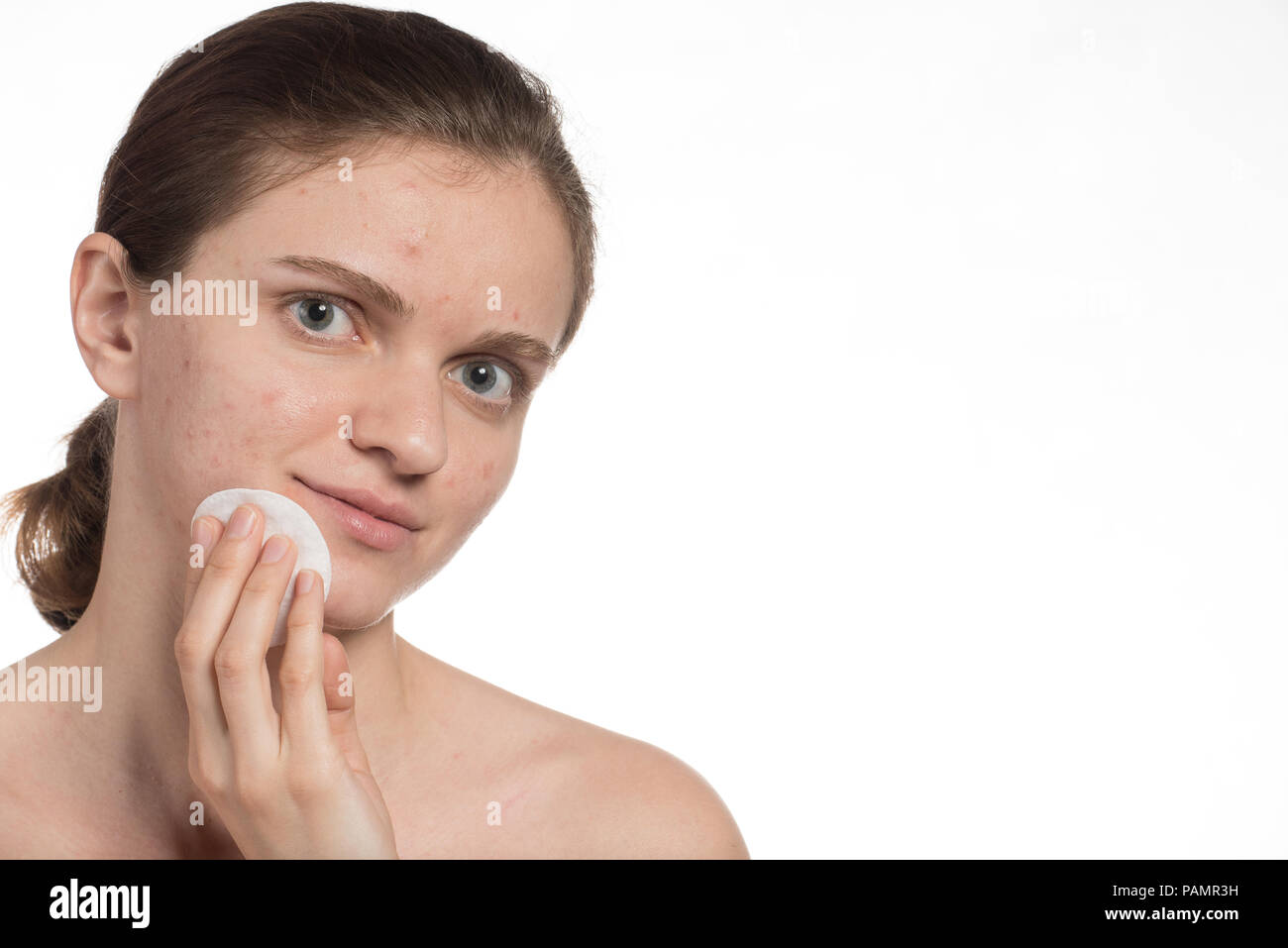 Bella ragazza giovane con il rosso e bianco acne sul viso. Prima e dopo la crema con una spugna. Smettere di acne su uno sfondo bianco. Foto Stock