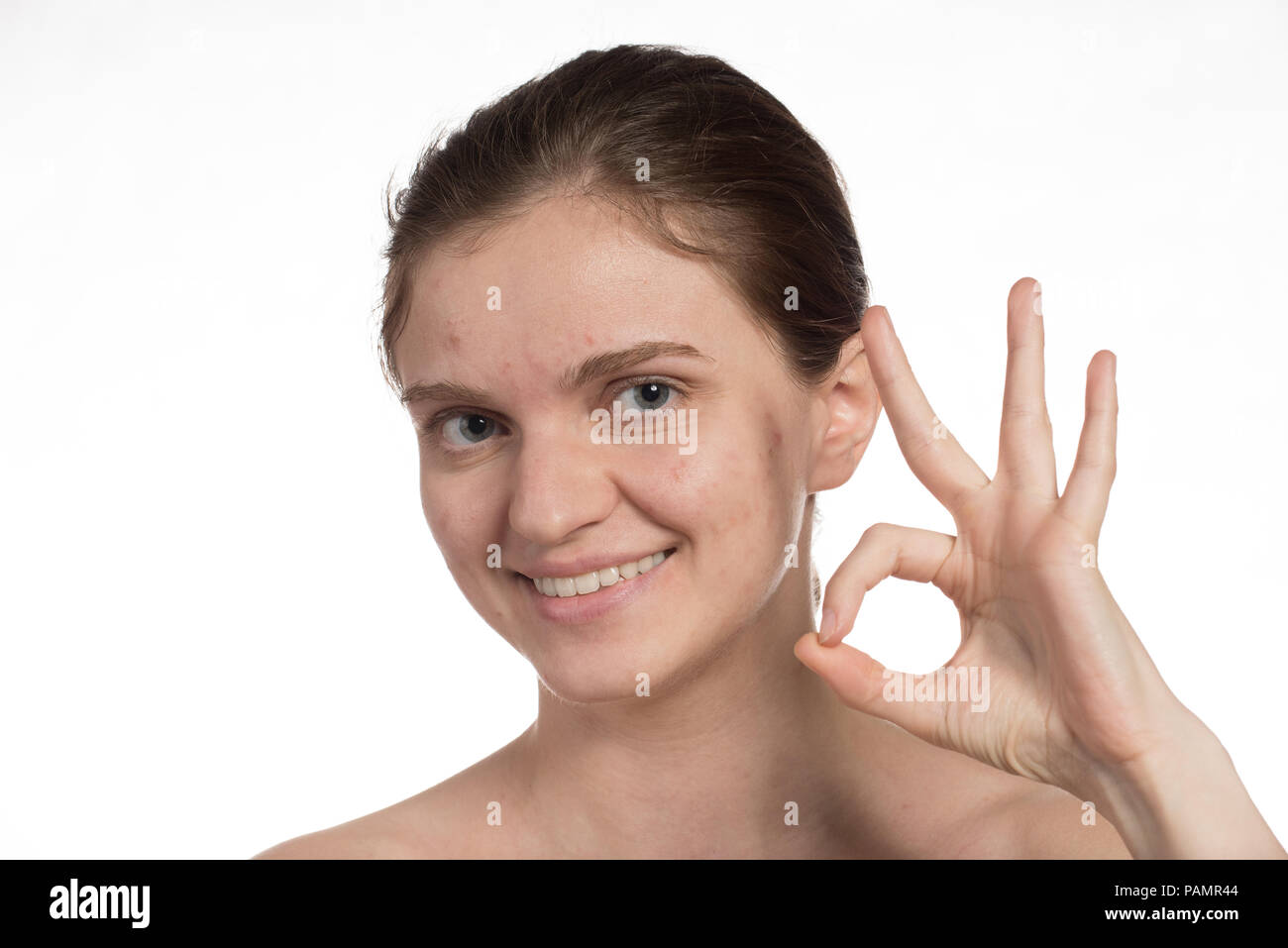 Bella ragazza giovane con il rosso e bianco acne sul viso. Prima e dopo la crema con una spugna. Smettere di acne su uno sfondo bianco. Foto Stock