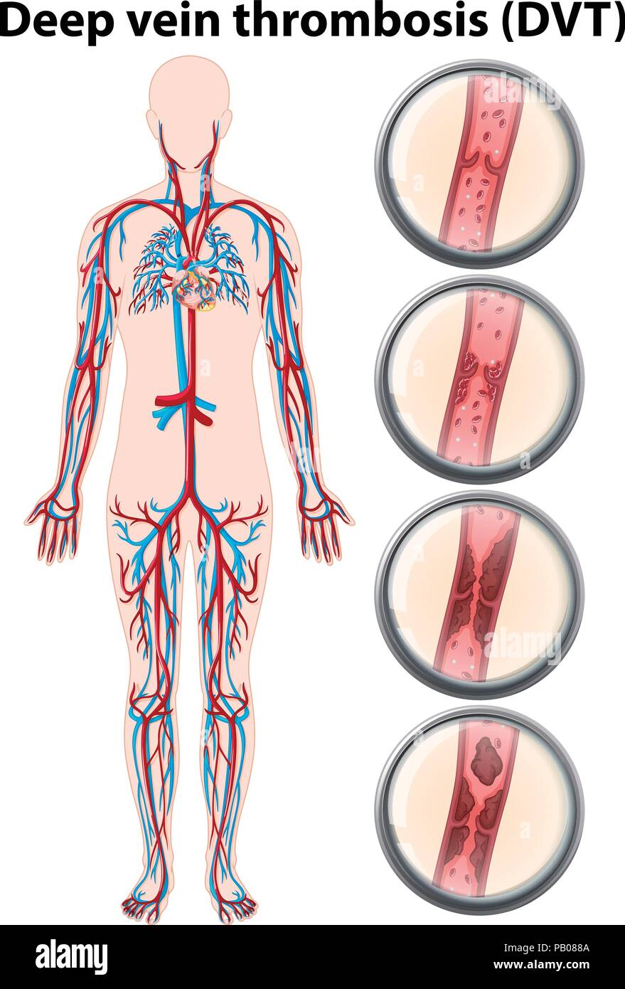 La trombosi venosa profonda illustrazione anatomia Illustrazione Vettoriale