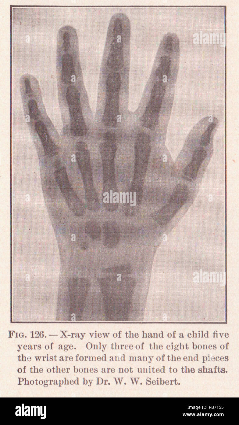 1185 PG 196 Xray del bambino la mano Foto Stock