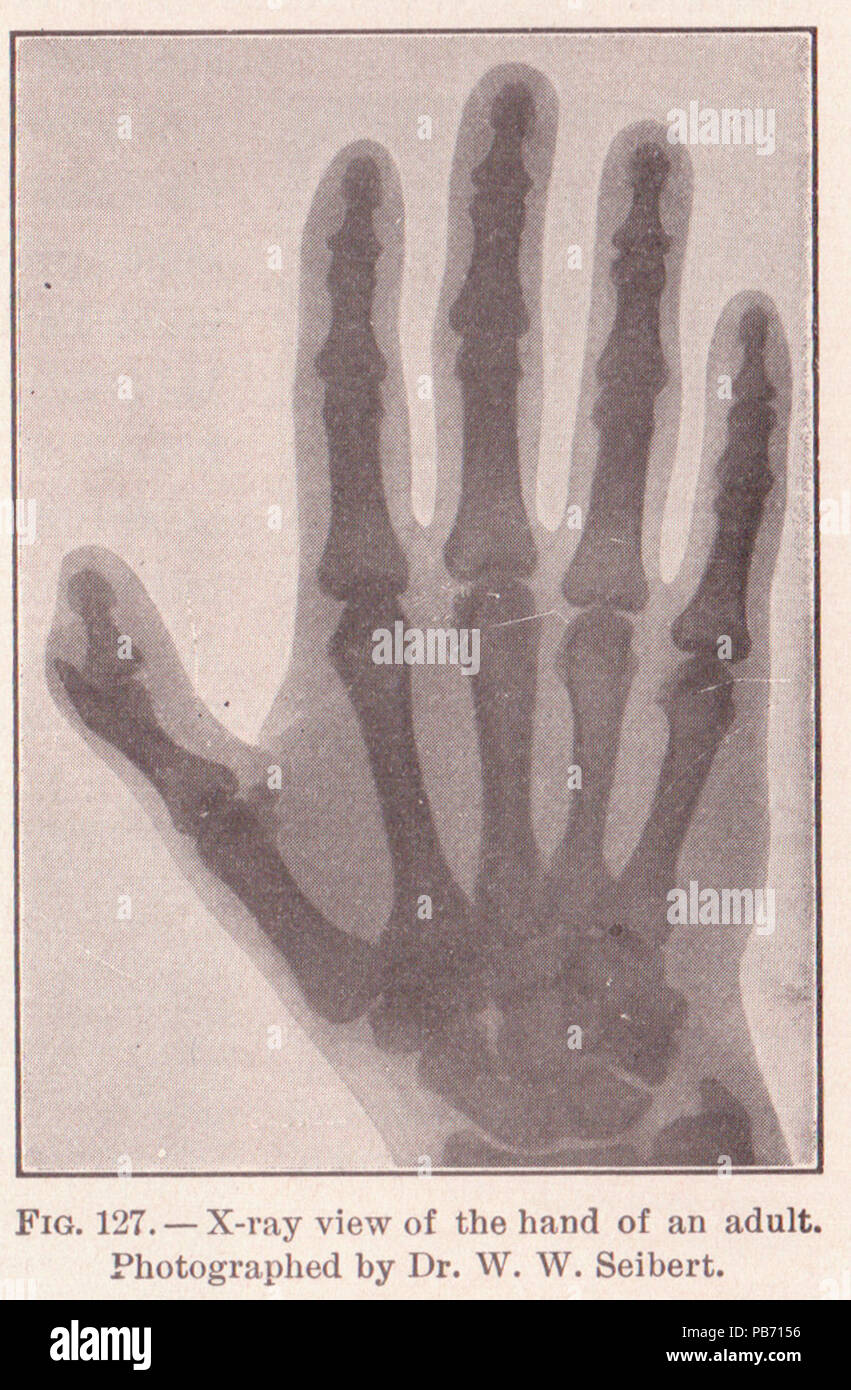 1185 PG 197 Xray di mano per adulti Foto Stock