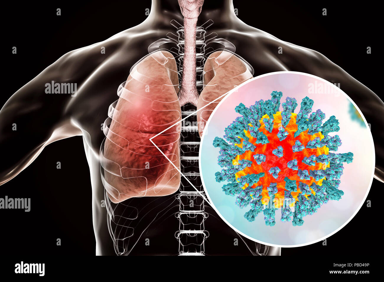 La polmonite causata dal virus del morbillo, concettuale illustrazione del computer. Virus del morbillo, virus dal Morbillivirus gruppo di virus, consiste di un RNA (acido ribonucleico) nucleo circondato da un involucro studded con le proteine di superficie emagglutinina-neuraminidasi e proteina di fusione, che vengono usati per collegare e penetrare in una cellula ospite. Il morbillo è altamente contagiosa pruriginoso con la febbre. Esso riguarda principalmente i bambini, ma un attacco di solito dà vita lunga immunità. La polmonite è uno dei comuni complicazioni del morbillo. Foto Stock