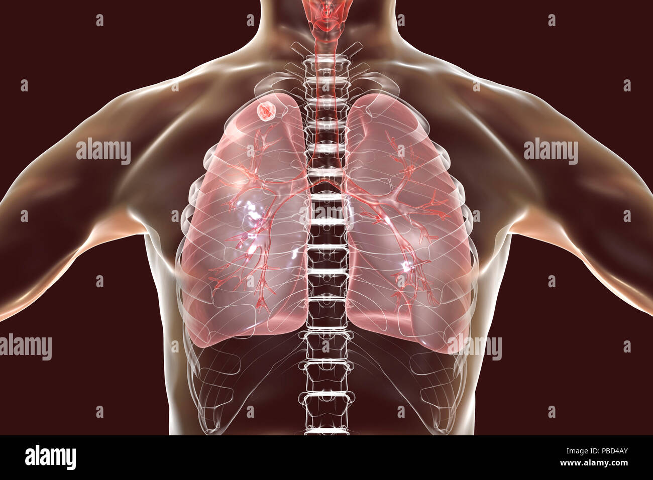 Secondaria infezione da tubercolosi. Computer illustrazione che mostra di piccole dimensioni nodulare solida massa situato nel lobo superiore del polmone destro vicino all apice del polmone. Foto Stock