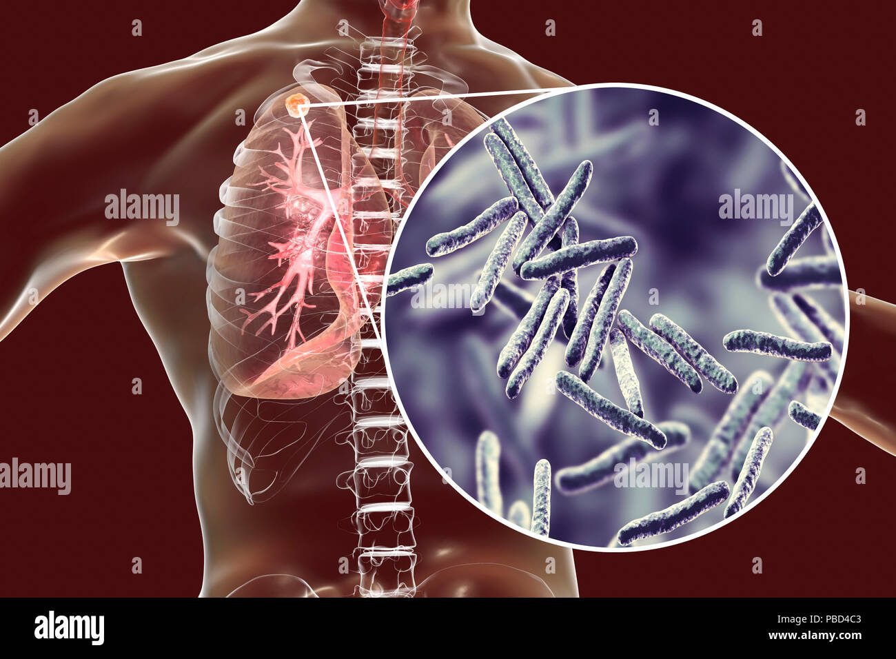 Secondaria infezione da tubercolosi e vista ravvicinata di Mycobacterium tuberculosis batteri, l'agente causativo della tubercolosi. Computer illustrazione che mostra di piccole dimensioni nodulare solida massa situato nel lobo superiore del polmone destro vicino all apice del polmone. Foto Stock