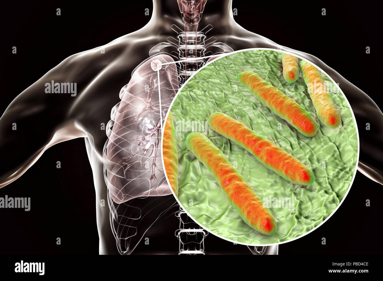 Secondaria infezione da tubercolosi e vista ravvicinata di Mycobacterium tuberculosis batteri, l'agente causativo della tubercolosi. Computer illustrazione che mostra di piccole dimensioni nodulare solida massa situato nel lobo superiore del polmone destro vicino all apice del polmone. Foto Stock